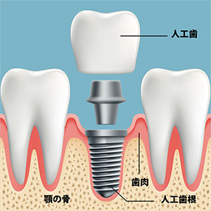 インプラント