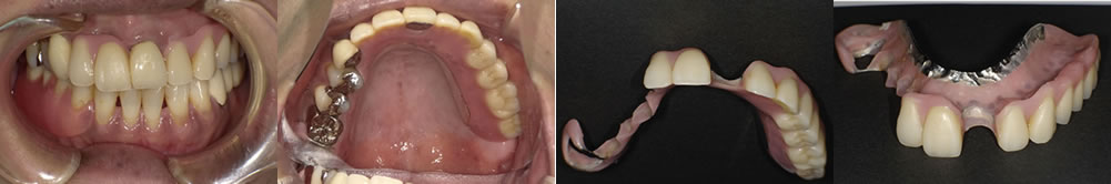 当院で実施した50代女性の入れ歯治療：ケース⑧