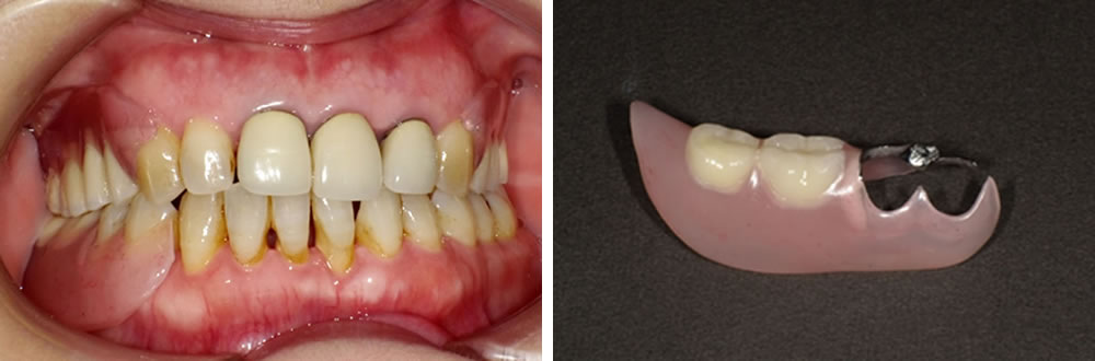 当院で実施した女性の入れ歯治療